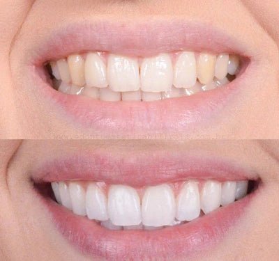Faccina™ - Sbiancante per denti
