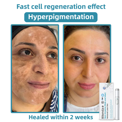 Penna laser Promax per la rimozione non invasiva di nei e verruche